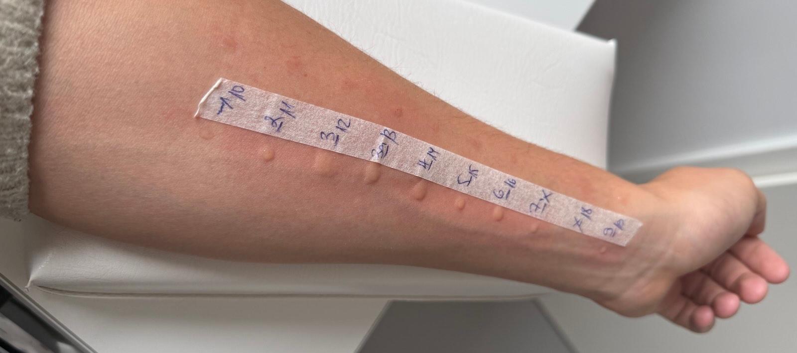 An allergy test Allergy test